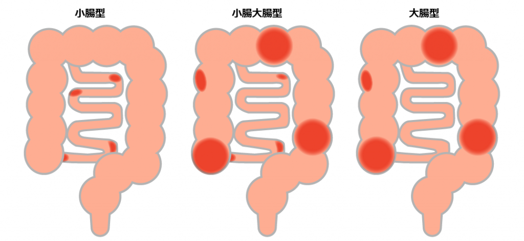 クローン病の手術後のサポートを見つける