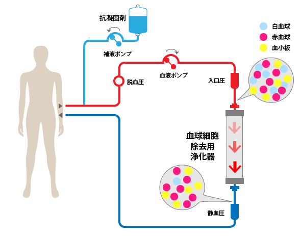 白血球除去(LCAP)の治療方法