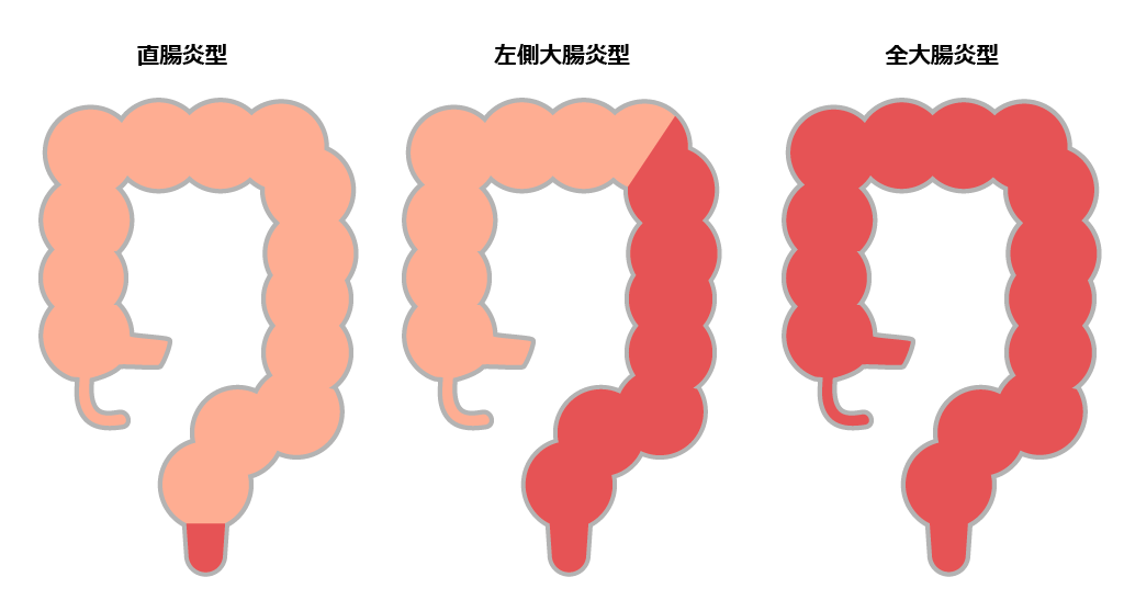 一時的なストーマのケア